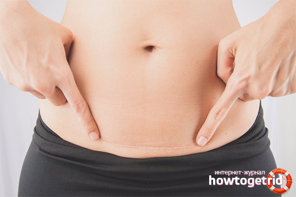 How to handle a suture after cesarean section