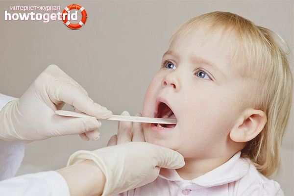 Herpes sore throat in children