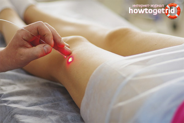 Procédures cosmétiques des étoiles sur les jambes