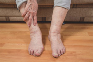 Leg swelling in the elderly
