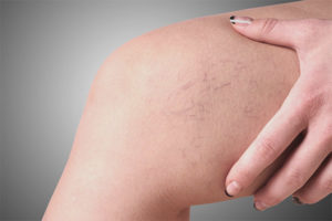 Spider veins on legs
