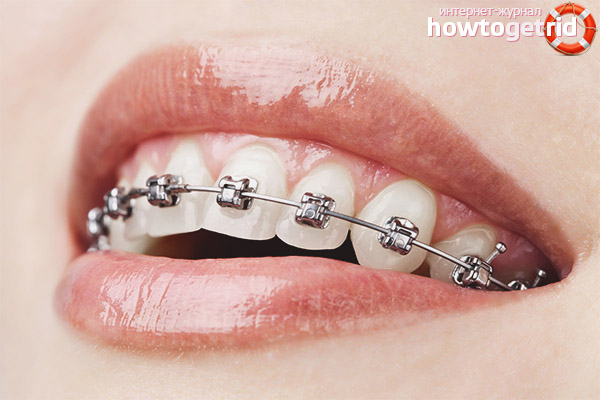Can I wear braces during pregnancy?