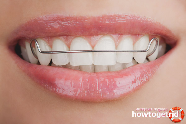 Maternity Bracket Tips