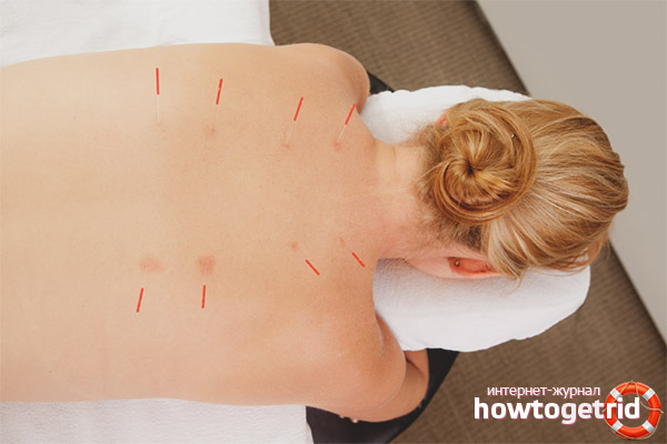 Effets bénéfiques de l'acupuncture