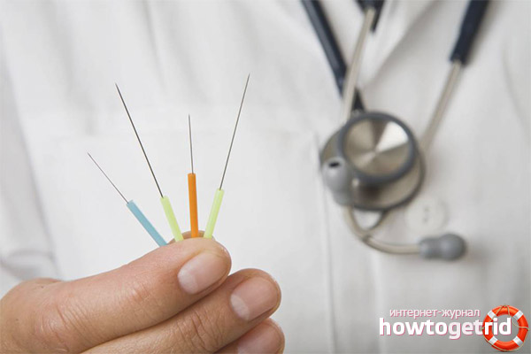 Quand l'acupuncture est-elle prescrite?