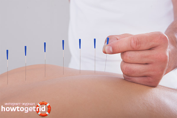 Les avantages et les inconvénients de l'acupuncture