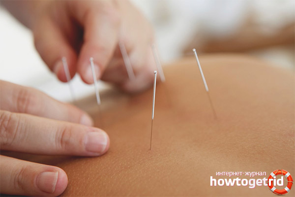 L'acupuncture a-t-elle un effet nocif sur le corps