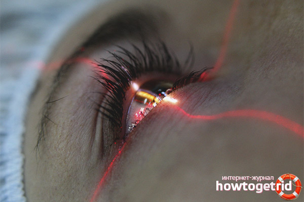 Laser vision correction