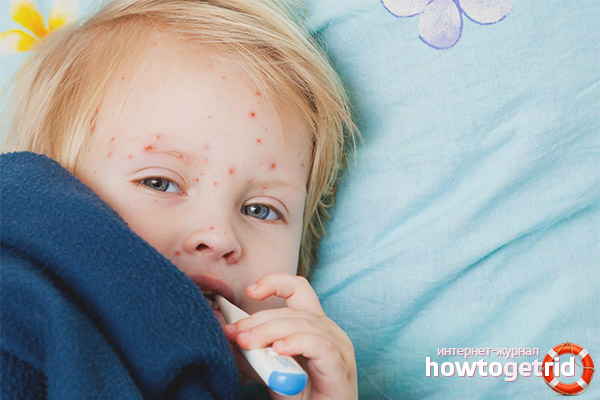 How to understand that a child has chickenpox