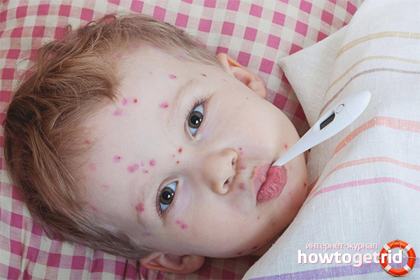 Treatment of chickenpox in children