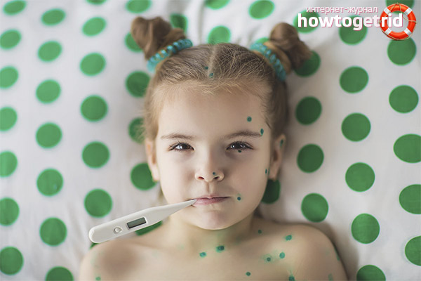Chickenpox in children