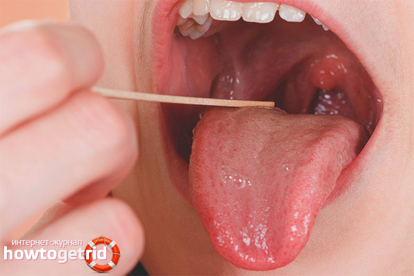 Is it possible to cure a sore throat without antibiotics